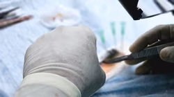 Murcia meldet Rekordzahl bei Lebertransplantationen