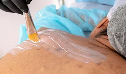 Erste Gentherapie bei Schmetterlingskinder in Spanien